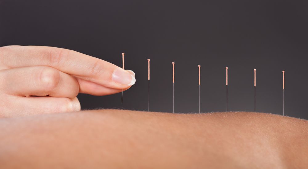 Try Acupuncture
